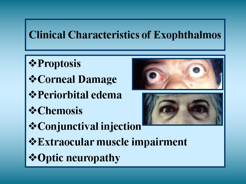 Clinical Characteristics of Exophthalmos Proptosis Corneal Damage Periorbital edema Chemosis Conjunctival injection Extraocular muscle